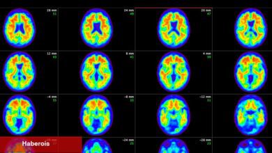Alzheimer'ı Çok Erken Tedavi Etmek Düşüşü Yavaşlatmak İçin Daha İyi Bir Umut Sağlıyor, Çalışma Bulguları