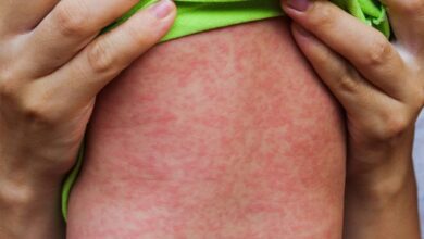 TTB AHEK’ten Kızamık Anketi: Zatürre Olarak Girilmiş, İkinci Sırada Bursa Var! - Haberois TTB AHEK’ten Kızamık Anketi: Zatürre Olarak Girilmiş, İkinci Sırada Bursa Var!