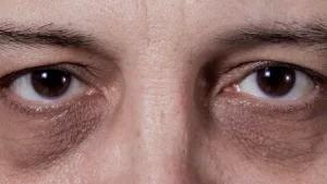 Göz altı morlukları olanlar buraya: 6 formül ile değişime inanamayacaksınız - Haberois Göz altı morlukları olanlar buraya: 6 formül ile değişime inanamayacaksınız