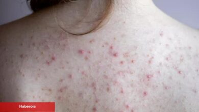 Herkesin rahatsız olduğu sorunun metodu bakın neymiş? Beden sivilceleri nasıl geçer?