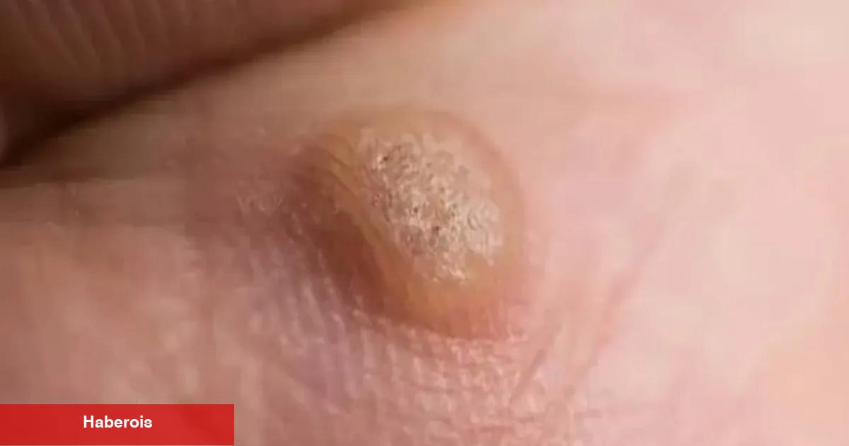 Ayakta ve genital bölgede çıkan siğile dikkat!
