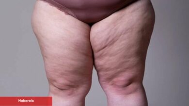 Lipödem nedir, nasıl anlaşılır? - Haberois Lipödem nedir, nasıl anlaşılır?