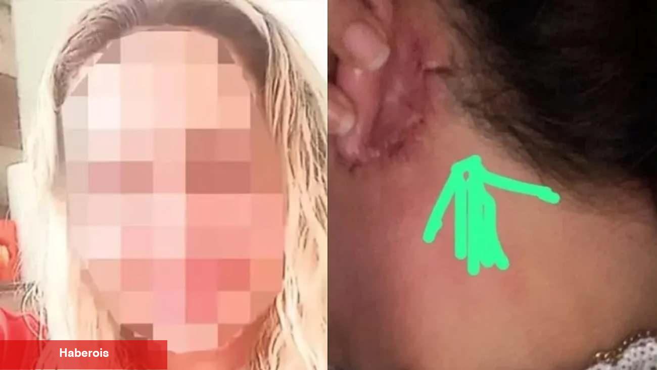 Hoşlaşmak isterken kabusu yaşadı! Kulağı kesilip yüzüne dikildi