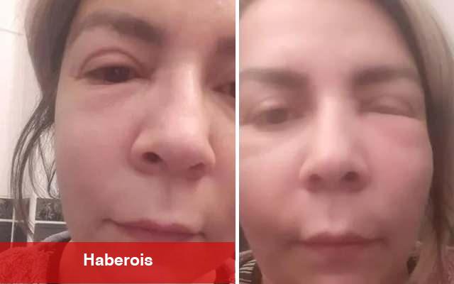 Yüzüne vitamin enjekte etmek istedi, tanınmaz hale geldi!