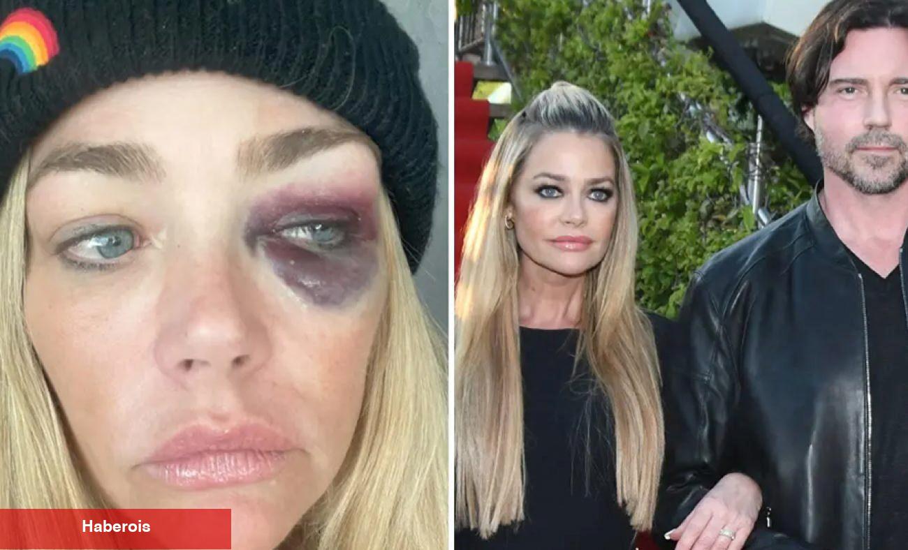 Gözleri mosmor olan Denise Lee Richards'tan eşine ağır suçlamalar: Beni öldürmeye çalıştı