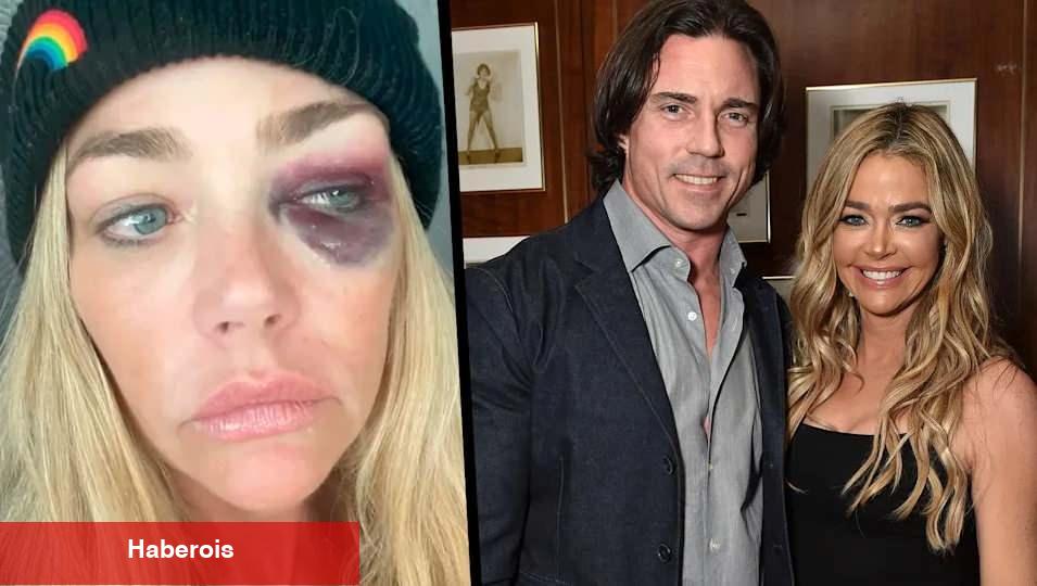 Gözleri mosmor olan Denise Lee Richards'tan eşine ağır suçlamalar: Beni öldürmeye çalıştı