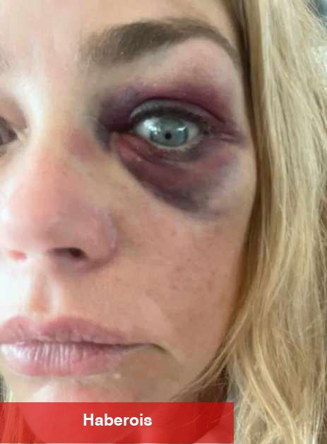 Gözleri mosmor olan Denise Lee Richards'tan eşine ağır suçlamalar: Beni öldürmeye çalıştı