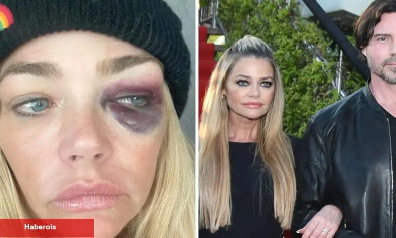 Gözleri mosmor olan Denise Lee Richards'tan eşine ağır suçlamalar: Beni öldürmeye çalıştı